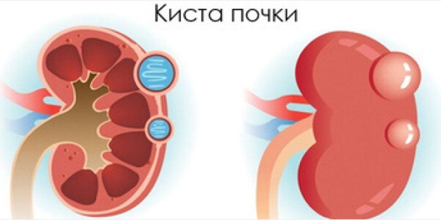 Перипельвикальные кисты почек: незаметные, но значимые